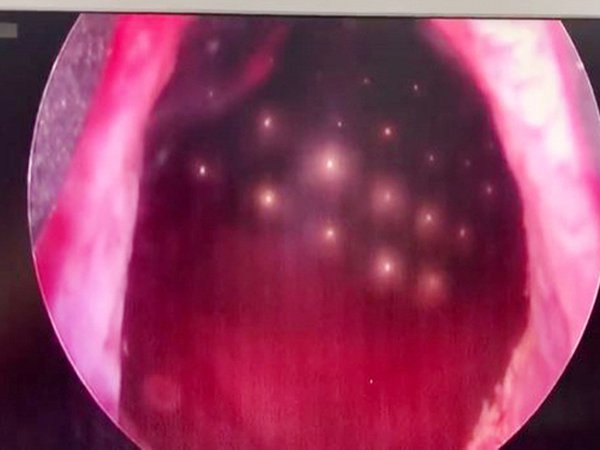 70顆磁珠塞進下體 11歲男童：尿尿特別痛！