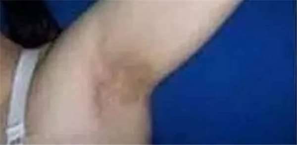 鏡子是半個醫生，照出身上有「這個」千萬別猶豫，馬上去醫院就對了！ -