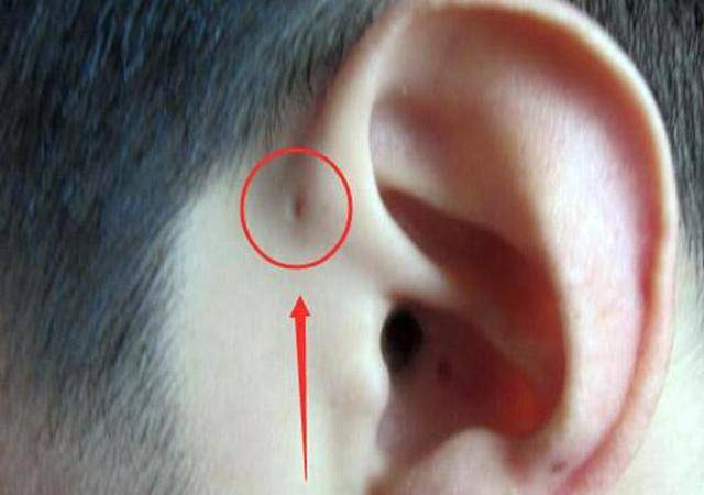孩子生下來耳朵上就有小孔？不是福氣，爸媽要心裡有數，不容忽視