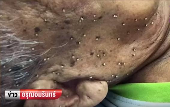 太夭壽！85歲高齡老翁慘遭數百蜜蜂圍攻，「蜂針像一顆顆白白粉刺」布滿臉超驚悚！ 