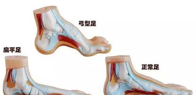 走路腳跟疼，像踩到釘子一樣疼？教你4招，迅速止疼，遠離足底筋膜炎