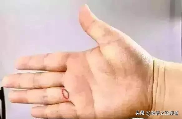 【捏捏手指，簡單預防7大疾病！】