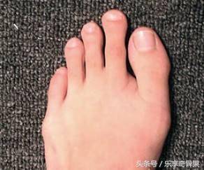 腎臟不好，耳朵會有3個表現，如果你沒有，說明腎臟比較健康 