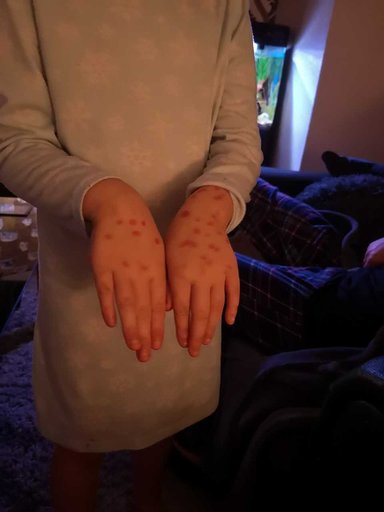 6歲機智妹用馬克筆「畫水痘」企圖逃學 10分鐘後馬上後悔：媽媽救我
