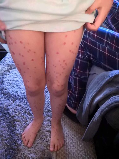 6歲機智妹用馬克筆「畫水痘」企圖逃學 10分鐘後馬上後悔：媽媽救我