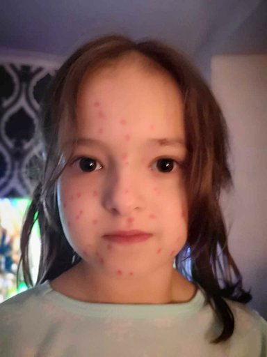 6歲機智妹用馬克筆「畫水痘」企圖逃學 10分鐘後馬上後悔：媽媽救我