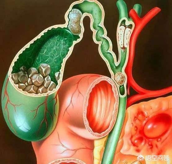 請問膽囊炎在生活中需要注意什麼？ 勞累、心情、喝酒等是否會使膽囊炎嚴重呢