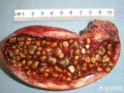 請問膽囊炎在生活中需要注意什麼？ 勞累、心情、喝酒等是否會使膽囊炎嚴重呢