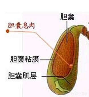 請問膽囊炎在生活中需要注意什麼？ 勞累、心情、喝酒等是否會使膽囊炎嚴重呢