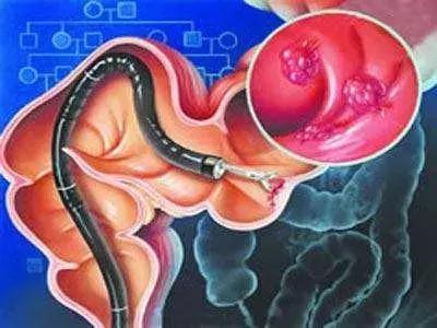 20歲小伙便血入院，查出直腸癌，醫生：這種「息肉」小心癌變