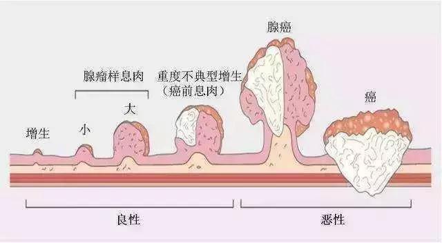20歲小伙便血入院，查出直腸癌，醫生：這種「息肉」小心癌變