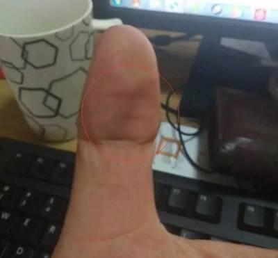 大拇指出現這一信號，就是中風前兆！防中風教您一套手指操！