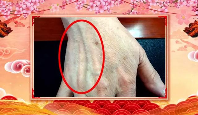 心臟狀況手上看出來！兩個方子通絡降脂、祛火潤燥，清除健康隱患