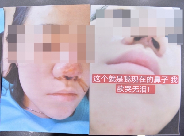 17歲少女耗資8500令吉隆鼻，自稱有10多年經驗的美容師就做成這樣？