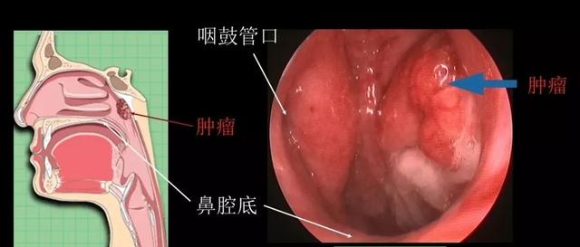 你以為是上火，其實是「癌」！7歲娃也中招！