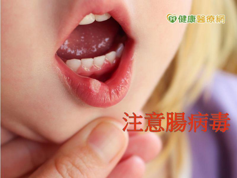 71型腸病毒來勢洶洶 出現這些症狀快就醫！