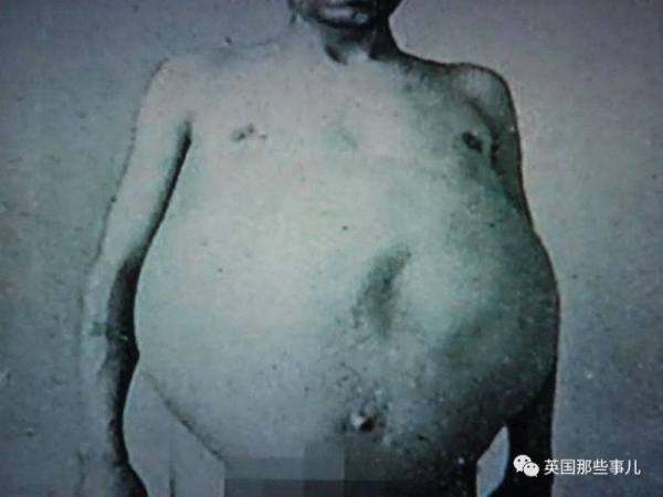 這名男子擁有史上「最大啤酒肚」當醫生一剖開他的肚子後，就決定將他「永遠收進博物館中」