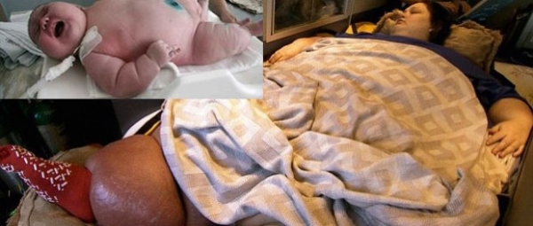 澳洲300公斤孕婦臨盆竟「出動直升機」!沒想到嬰兒出生後的模樣,連護士都嚇一大跳了!