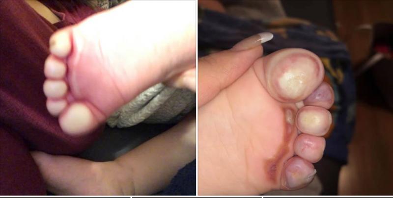 兒童涼鞋竟然令女兒的腳三度灼傷！為孩子買鞋的媽媽們可要小心了！