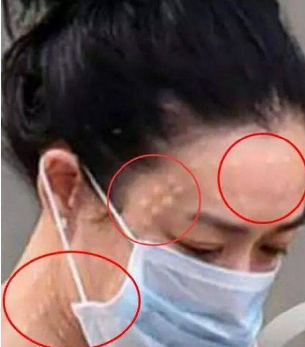  46歲鍾麗緹遭偷拍「臉上滿滿針孔」！女星為了不老「亂打針的下場」竟是....嚇到腿軟！