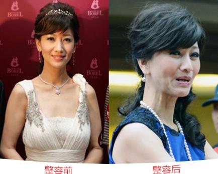  46歲鍾麗緹遭偷拍「臉上滿滿針孔」！女星為了不老「亂打針的下場」竟是....嚇到腿軟！