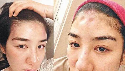女星遭51歲富商男友家暴，打成腦震蕩頭骨骨折還吐血慘不忍睹~