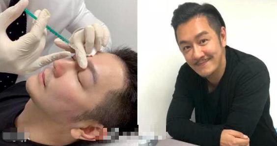 陳浩民曬醫美照！毫不避諱自己做微調，男明星為「美」也這麼拼？