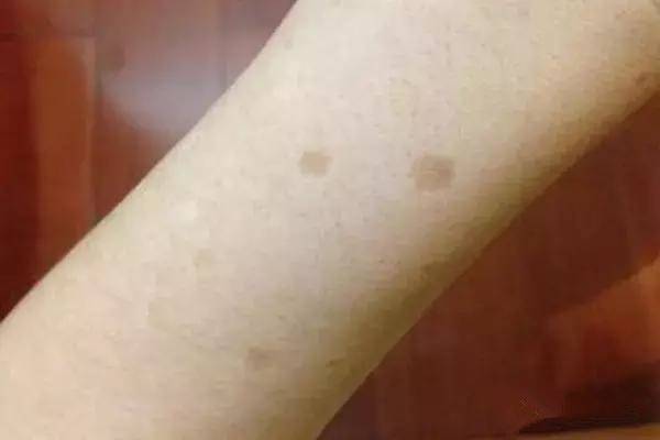 老年斑是衰老的象徵，出現了別擔心，2個小動作讓你告別老年斑重回年輕