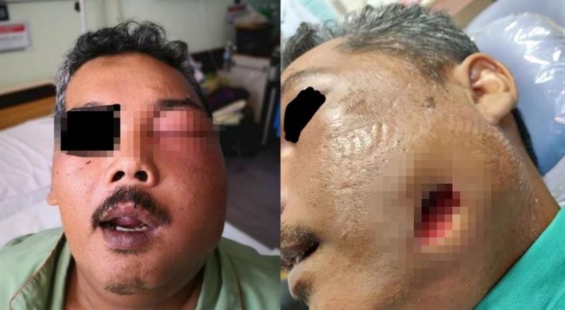 聽信偏方！抹煞車油止牙痛 醫驚呆