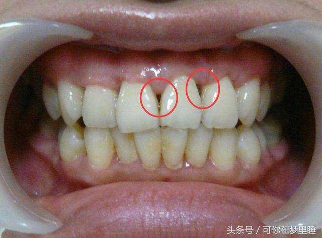 [牙齦]一旦萎縮，就容易[塞牙]、[牙根酸痛]，這方法可以幫到你，很簡單！