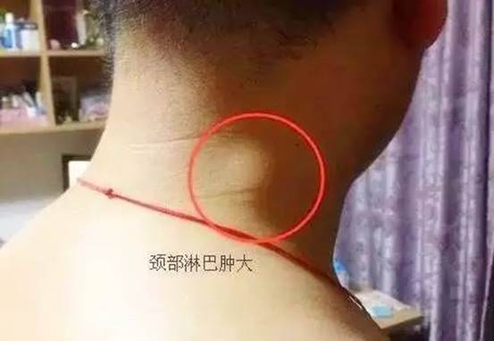 人體三處淋巴關係身體健康，老中醫分享淋巴按摩，關鍵時可能救你一命 !