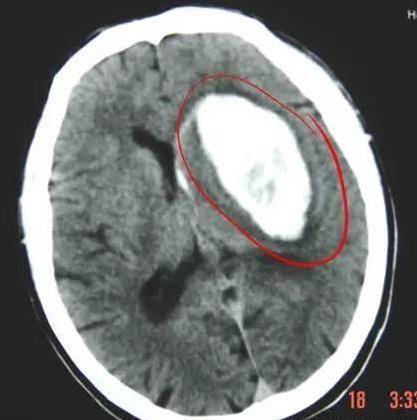 「中風」的人越來越多，也越年輕！醫生奉勸：3 種食物別吃，會「加速」血管堵塞！保護好腦血管，日常做好這4件事！