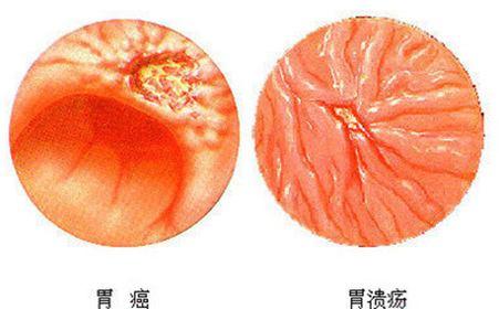 7個原因導致胃潰瘍。醫生指出：按著這個方案治療可以痊癒