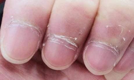 夏季孩子更易缺鋅，父母忽視，孩子長不高 