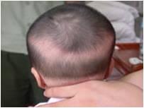孩子枕禿是缺鈣的表現嗎？科學補鈣，要避開這些誤區哦