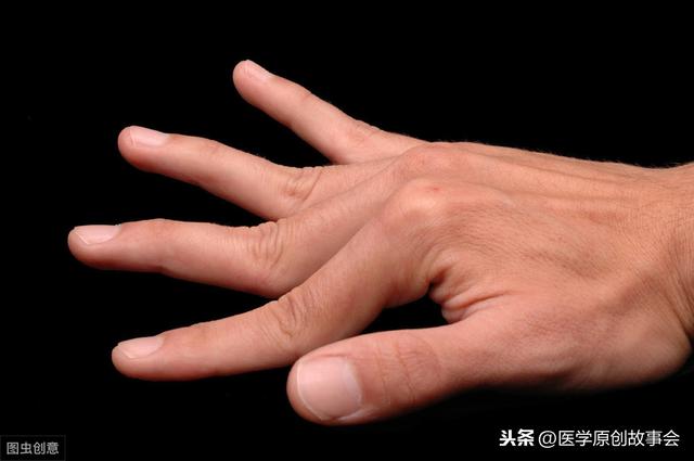 體內有癌，手指先知，手指若有這一個特徵，癌症可能已經到訪