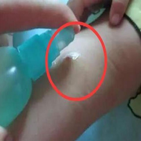 蚊子咬了腫一包奇癢難忍？越抓越癢，教你止癢方法，60秒後止癢去痕！