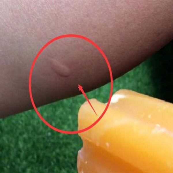 蚊子咬了腫一包奇癢難忍？越抓越癢，教你止癢方法，60秒後止癢去痕！