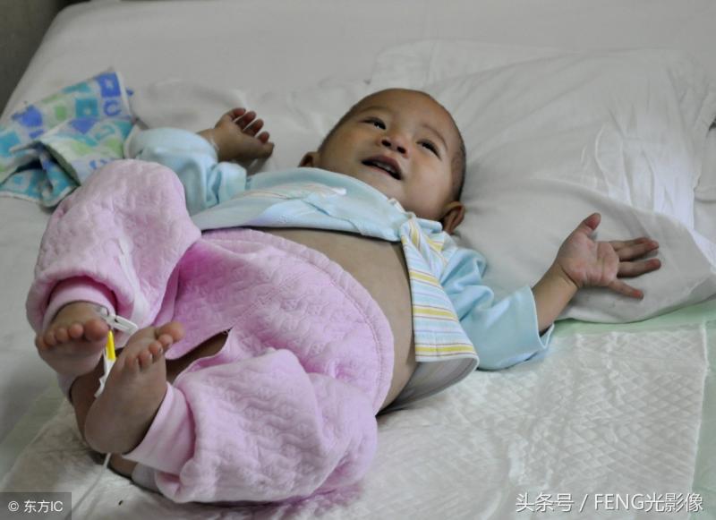 史上最小「孕婦」，因孩子是因寄生胎肚子才變大的，親生父母系全責！