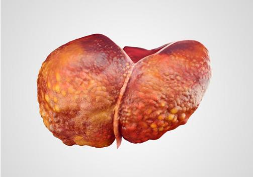 51歲男子腹痛入院，查出肝癌，醫生惋惜：都是餐桌上這兩物害的