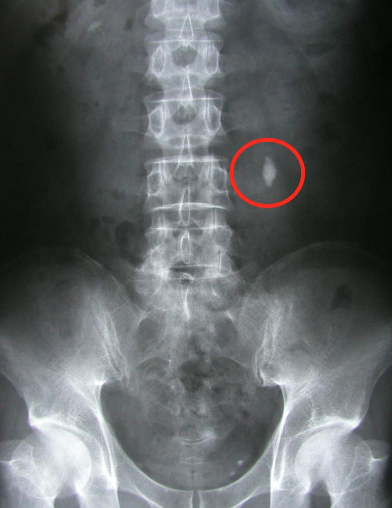 少喝水，「結石」塞滿腎！ 醫師：這顆不行了！