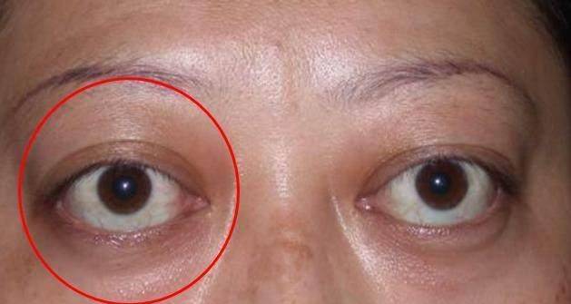 一旦眼睛出現這「8種癥狀」要當心，這可能是大病的徵兆，要及時就醫