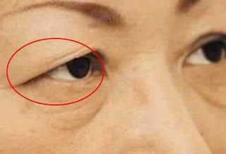 一旦眼睛出現這「8種癥狀」要當心，這可能是大病的徵兆，要及時就醫