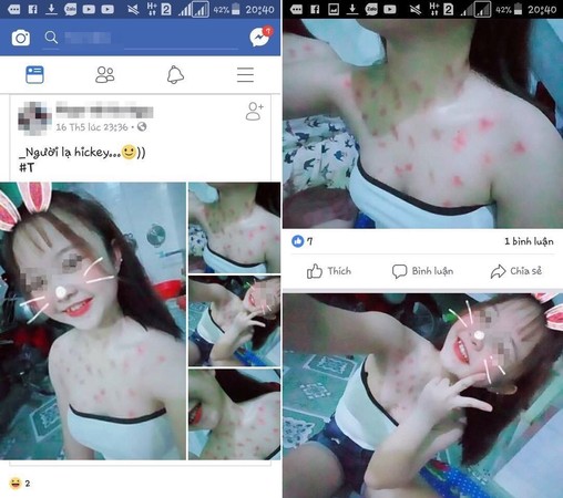 國中嫩妹曬整身被吸允的「草莓」白皙上身至少60粒，網友：妹妹母湯哦！