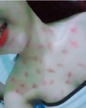 國中嫩妹曬整身被吸允的「草莓」白皙上身至少60粒，網友：妹妹母湯哦！