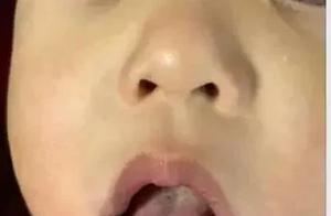 孩子積食嚴重，濕熱重、體內積滯多，容易被傳染手足口