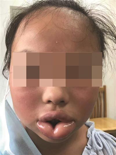10歲女童咬了一口桃子 嘴唇腫得像香腸(圖)