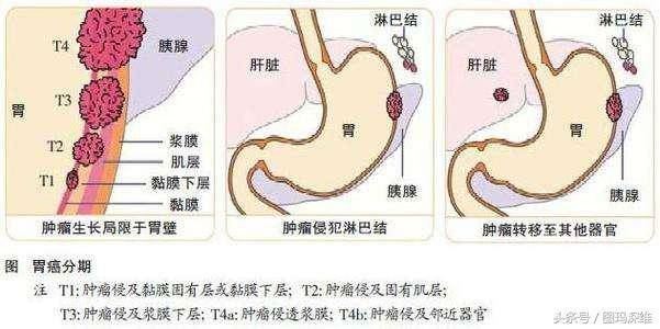 胃癌不痛不癢，一不留神就是晚期了，身體發現這4種情況要重視！
