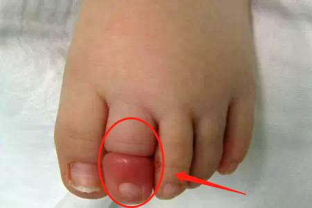 2歲兒子腳進「蟲」嚇壞寶媽，醫生看了說：再晚來一會就要截肢了