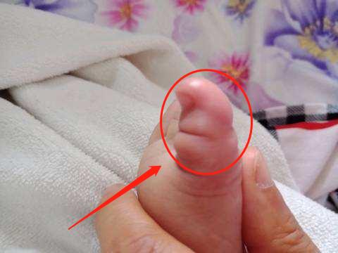 2歲兒子腳進「蟲」嚇壞寶媽，醫生看了說：再晚來一會就要截肢了